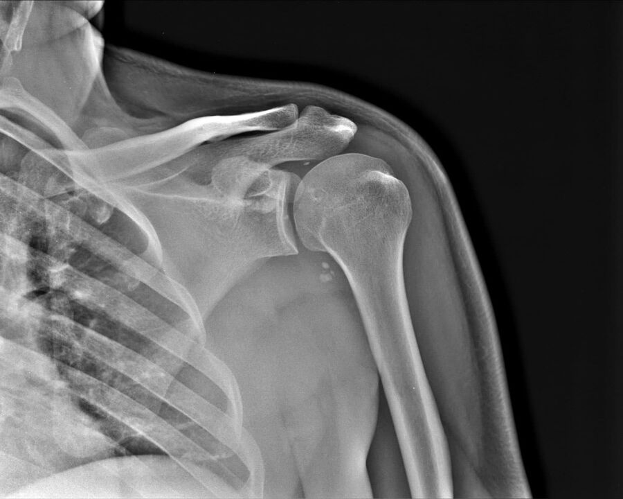 X-rays of the arthrosis of the shoulder joint of the second degree of severity
