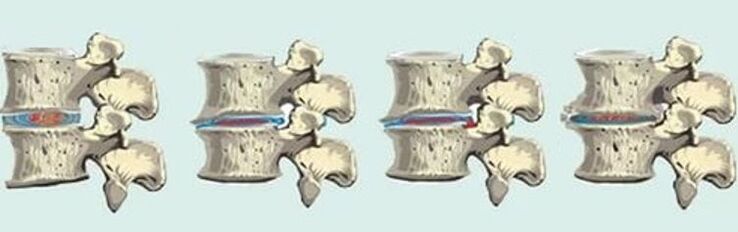 spinal lesions in case of thoracic osteochondrosis
