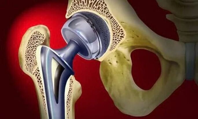 Replacement of hip joints for osteoarthritis