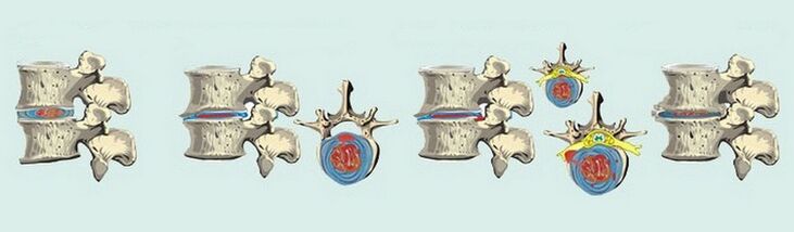 Stages of formation of spinal osteochondrosis