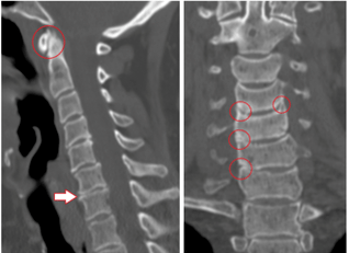 CT scan shows damaged vertebrae and discs of heterogeneous height due to thoracic osteochondrosis. 