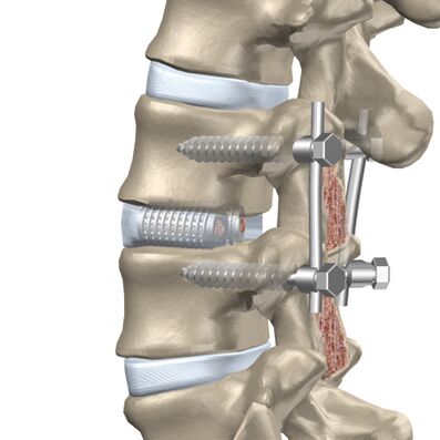 Replacement of a destroyed thoracic spine disc with an artificial implant