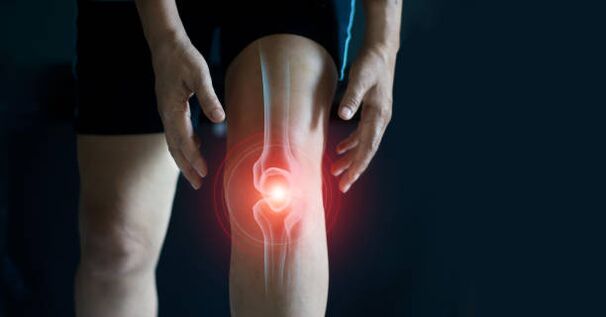 Arthritis of the knee joint