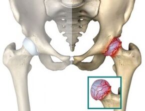 Causes of atrosis of the hip joint