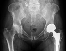 Diagnosis of hip joint arthrosis