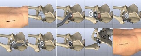 Hip arthrosis treatment methods