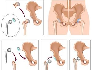 endoprosthetics for hip joint arthrosis