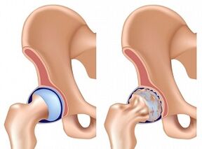 hip arthrosis symptoms